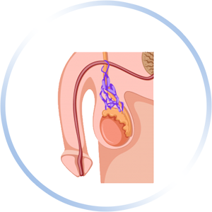 Varicocele