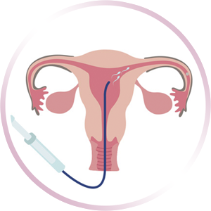 Inseminación Artificial