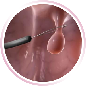 Pólipos Endometriales
